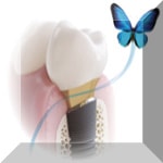 Experte Zahnimplantate Berlin Dr. Stoltenburg M.Sc.,M.Sc.,MPI /Tätigkeitsschwerpunkt Implantologie Experte Zahnimplantate Berlin Dr. Stoltenburg M.Sc.,M.Sc.,MPI /Tätigkeitsschwerpunkt Implantologie